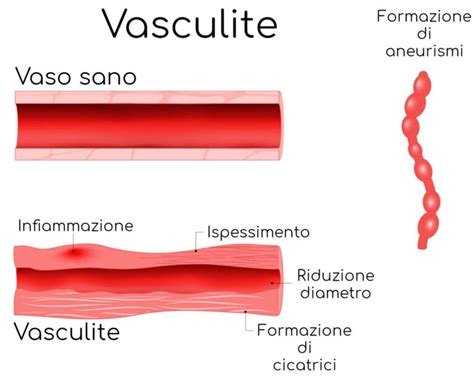 Vasculite Sintomi COVID E Altre Cause Cura Valori Normali