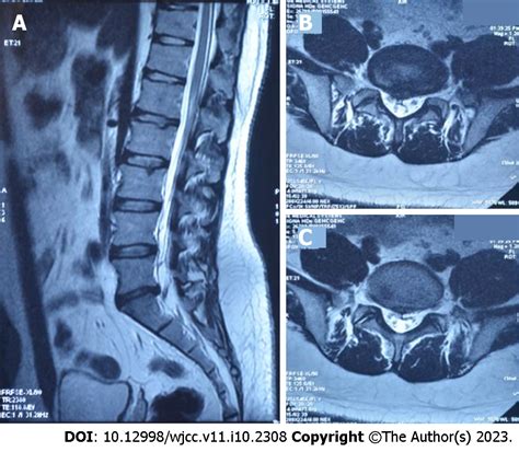 Reabsorption Of Intervertebral Disc Prolapse After Conservative