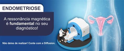 Saiba Tudo Sobre Endometriose Diffusion Medicina Diagn Stica