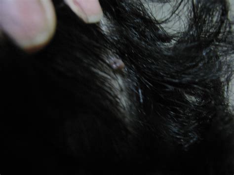 What is this in my scalp? Is it a cyst? : r/DiagnoseMe