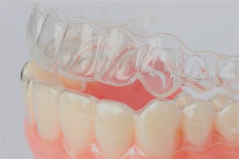 Smile Restoration: Overlapping Teeth Treatment in Dubai | by anaya george | Medium