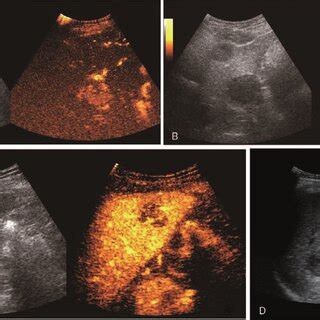 Contrast Enhanced Ultrasonography And Ultrasound Guided Puncture Of The