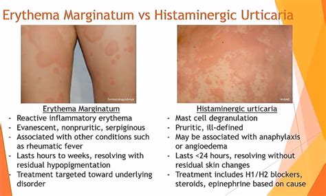 Erythema Marginatum Rheumatic Fever