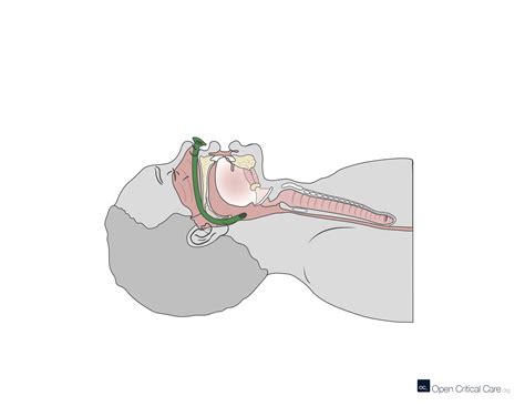 Sagittal Cross Section View Of Nasopharyngeal Airway Open Critical Care