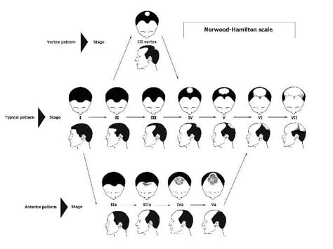 Understanding Male Pattern Baldness Anastasakis Hair Clinic