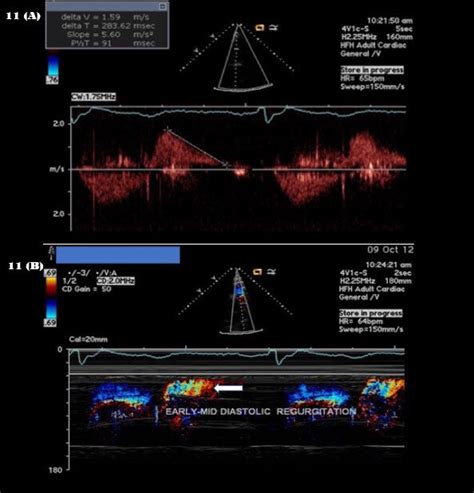 A And B Continuous Wave Doppler Across Right Ventricular Outflow Download Scientific Diagram