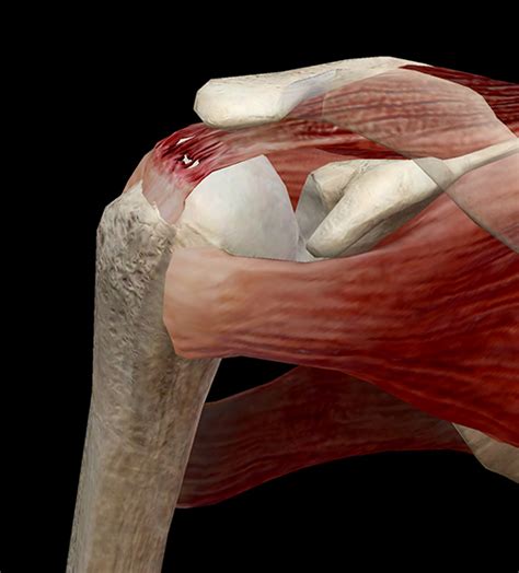 learn muscle anatomy  dads  rotator cuff injuries