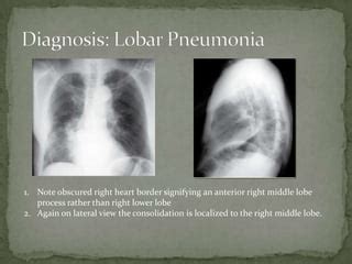 Lobar pneumonia Power Point | PPT