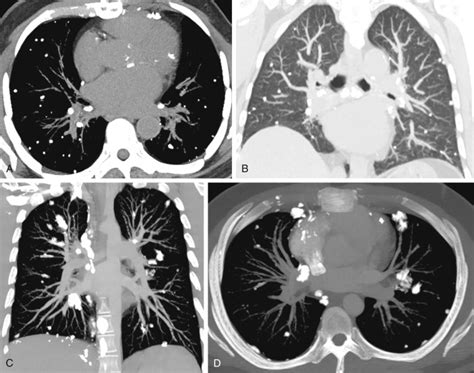 Diffuse Lung Disease With Calcification and Lipid | Radiology Key