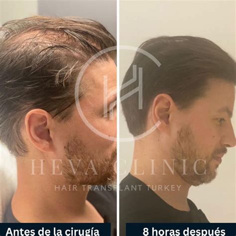 Implante De Pelo Sin Rapar La Soluci N Sin Cirug A Cirug A Capilar