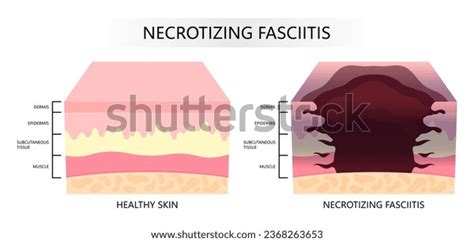 Epidermis Layer Skin Bacteria Necrotizing Fasciitis Stock Vector Royalty Free 2368263653