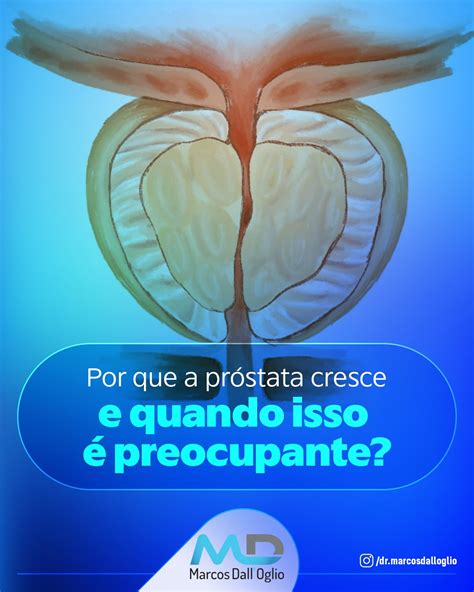 O Que Que É Próstata - Por que a próstata cresce? - Marcos Dall Oglio