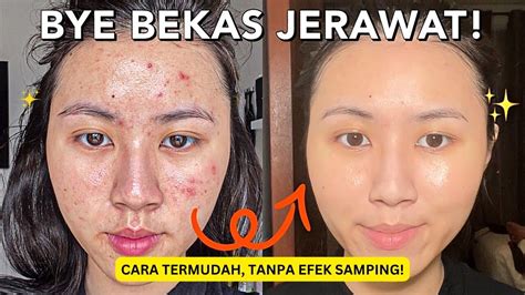 Asli Tanpa Modal Ini 7 Cara Mengecilkan Pori Pori Wajah Bekas Jerawat