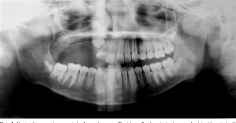 Figure 1 From An Unusual Size Of Ameloblastic Fibro Odontoma