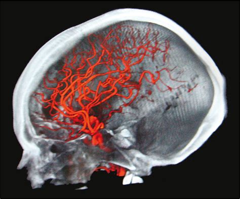 What Is Cerebral Aneurysm Symptoms Diagnosis And Treatments