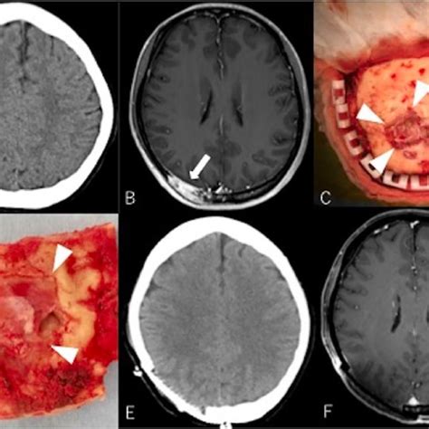 Preoperative Intraoperative And Postoperative Images From Case 1 A