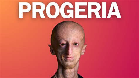 Descubriendo La Progeria Conoce Este Raro Trastorno Genético Youtube