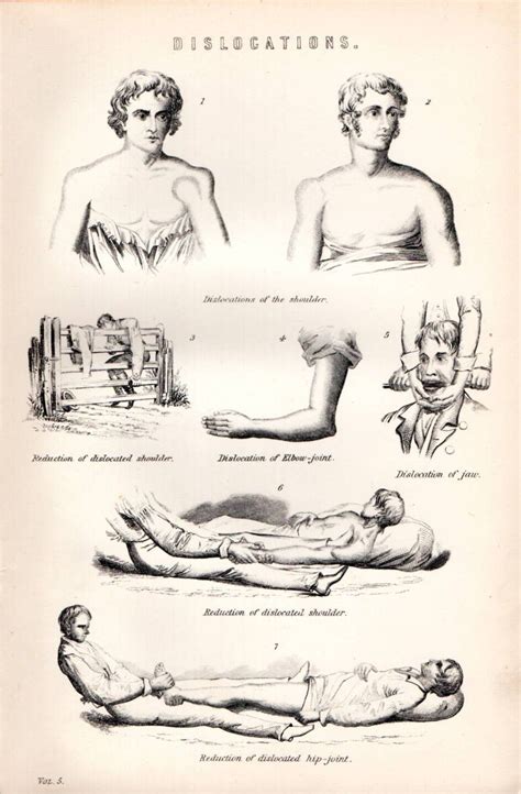 1880 Print ~ First Aid ~ Dislocation Hip Shoulder Jaw Elbow Reduction