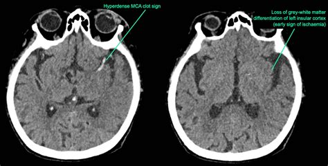 CT Case 005 LITFL CT Scan Interpretation