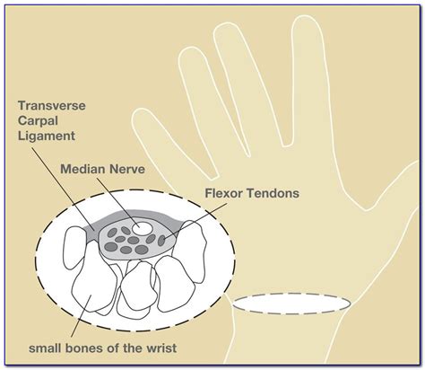 Carpal Tunnel Syndrome Diagram | prosecution2012