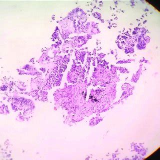 Bronchoscopy biopsy histopathology (×10) | Download Scientific Diagram