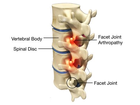 Can I Reapply Flea Treatment Early: Lumbar Facet Joint Syndrome Treatment