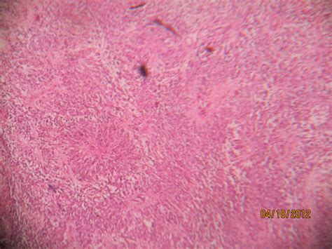 EPENDYMOMA – Histopathology.guru