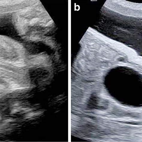 Normal Perineal Midsagittal Us View In Vesicoureteral Reflux A Normal