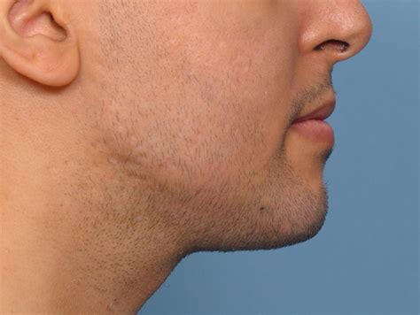 Male Chin Implant And Custom Jaw Angle Implants Result Side View 2 Dr