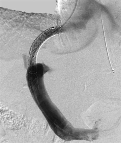 Transjugular Intrahepatic Portosystemic Shunt Ultrasound Evaluation