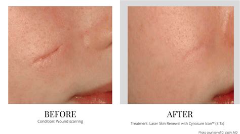 Scar Removal Laser Abu Dhabi at Robert Ferreira blog