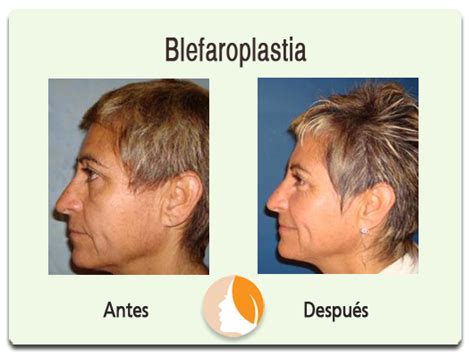 Blefaroplastia Dr Alejandro Campos Apaez