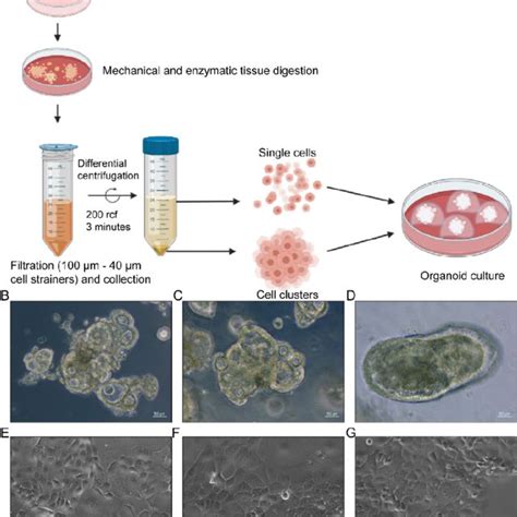 Generation Of Patient Derived Cholangiocarcinoma Cell Lines A