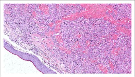 Hematoxylin And Eosin He Stained Biopsy Sample Obtained From The