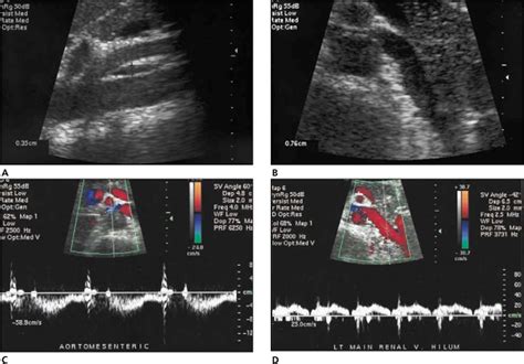 Nutcracker Syndrome Ultrasound