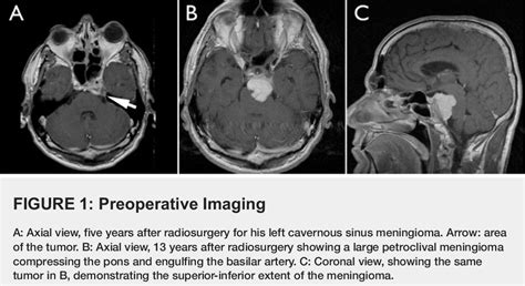 Figure From Endoscopic Endonasal Approach For Transclival Resection