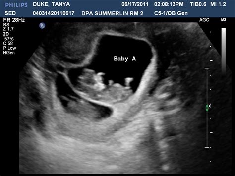 Ultrasound Pictures Of Identical Twins At 10 Weeks At Jacqueline Larose