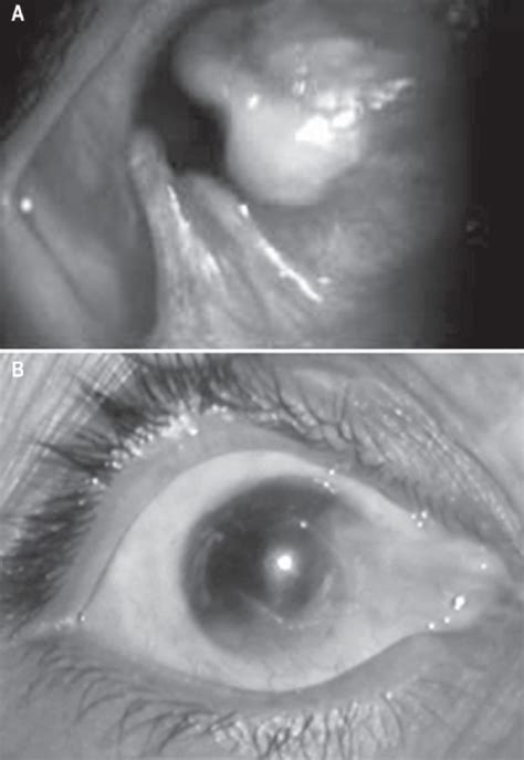 Slit Lamp Photograph Of A Patient With Total Limbal Stem Cell