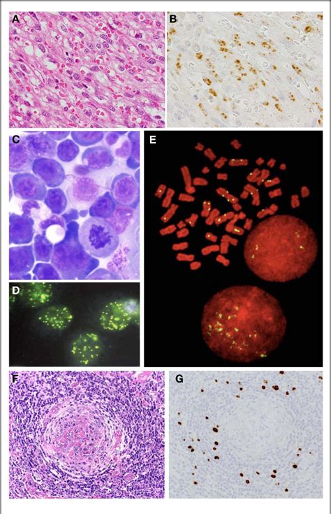 Figure From Pathology Of Kaposis Sarcoma Associated Herpesvirus