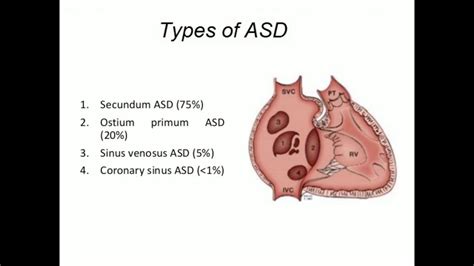 Sinus Venosus Atrial Septal Defect Youtube