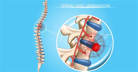 Thriving With A Herniated Disc Atlanta Ga Spine Surgery