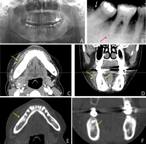 Treatment Of Life Threatening Acute Osteomyelitis Of The Jaw During Chemotherapy A Case Report