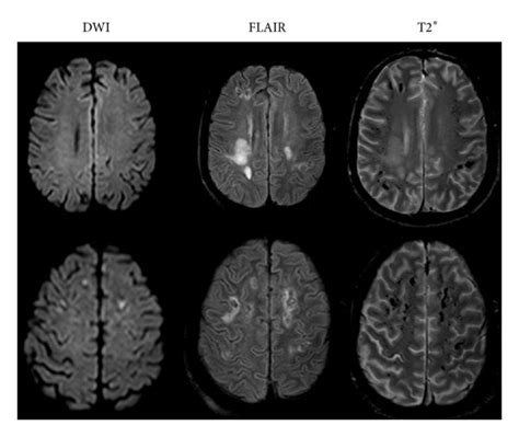 Mri Manifestations Of Patient 3 A Deep White Matter Edema In Download Scientific Diagram