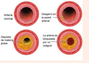 Arteriosclerosis Qué es síntomas causas y tratamiento de la