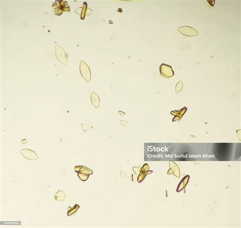 Photomicrograph Of Uric Acid Crystal In Urine Sediment Stock Photo