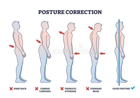 posture correction diagram shows  side view silhouettes