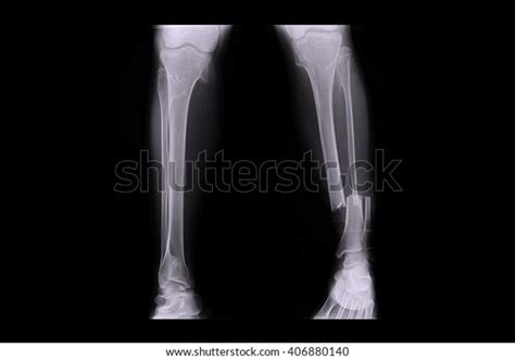 8,533 Broken Leg X Ray Images, Stock Photos & Vectors | Shutterstock