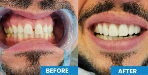 How Much Are Veneers In Istanbul Turkey Dt Ozlem Ozcan