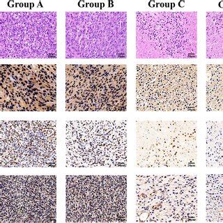 H E Staining And Hif Ki And Glut Immunohistochemical Staining