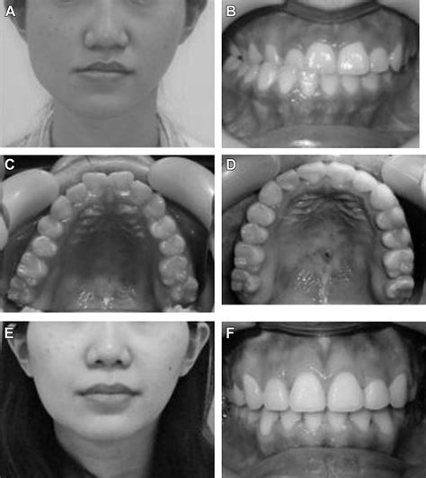 Miniscrew Implant Applications In Contemporary Orthodontics Chang